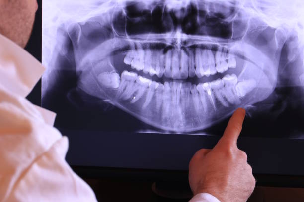 Best Emergency Wisdom Tooth Extraction in De Leon Springs, FL